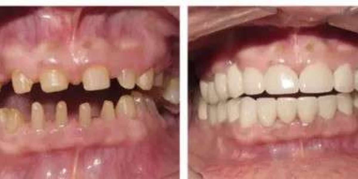 How to Care for Your Tooth Crown in Dubai for Long-Lasting Results