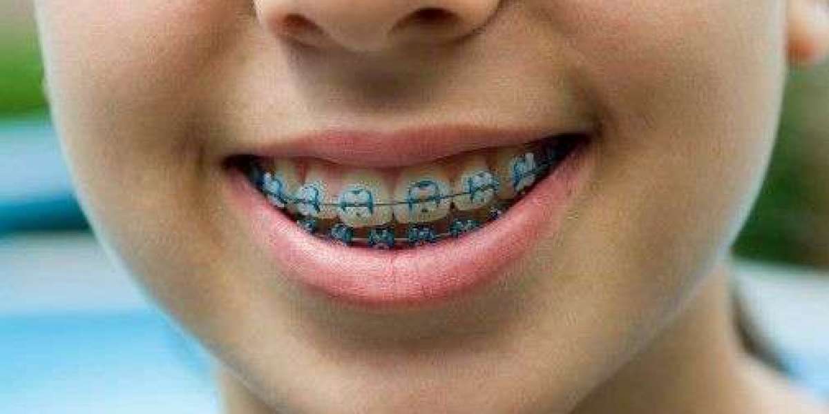 How to Choose Best Braces for Kids? | Step by Step Guide