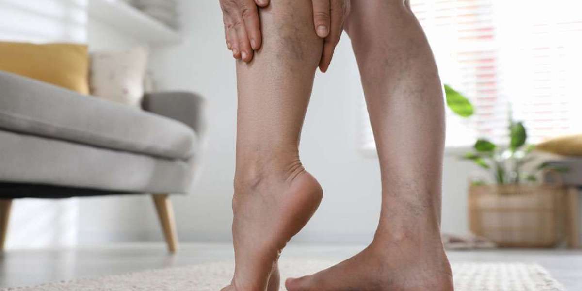 Spider Vein Prevention Tips Manchester Experts