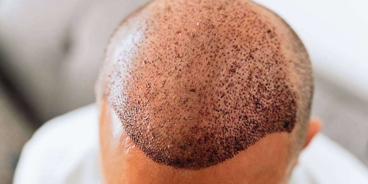 Hair Transplantation: Myths & Facts