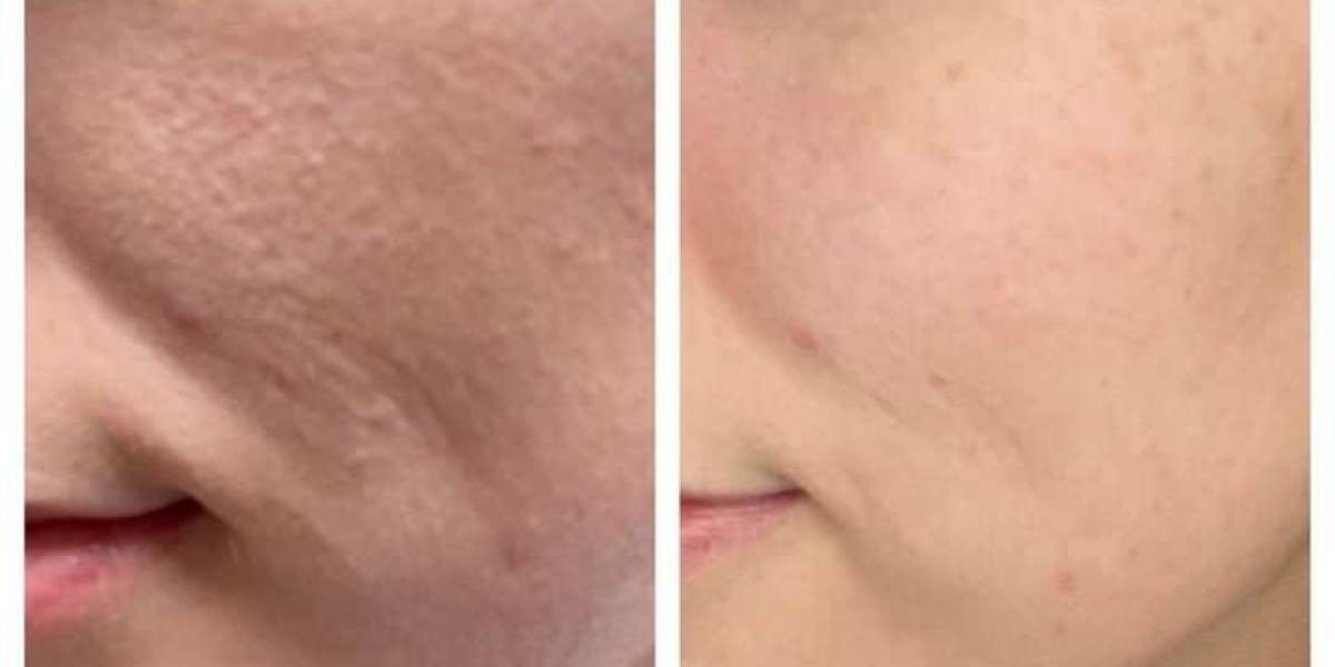 Microneedling for open pores