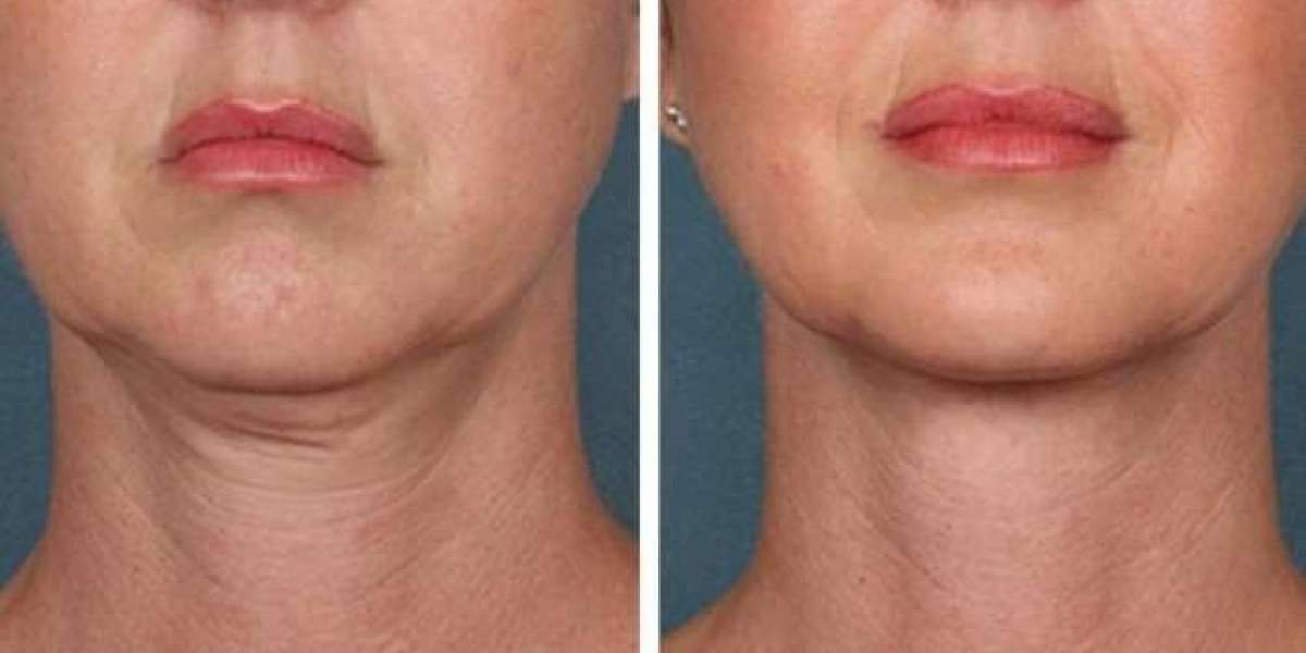 PRP Treatment in Dubai for Hair Nourishment