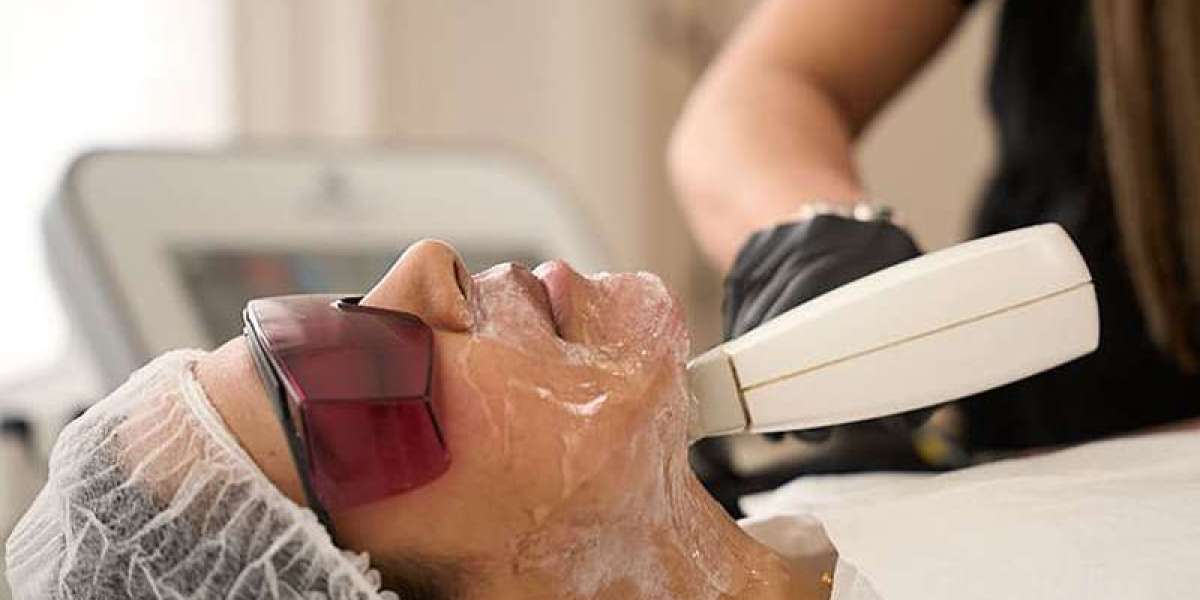 Laser for Pigmentation in London – Advanced Laser Treatments to Correct Discolouration and Improve Skin Clarity