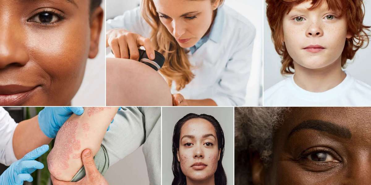 Chemical Peel Treatment in Indirapuram – Advanced Skin Renewal at The Skin Global
