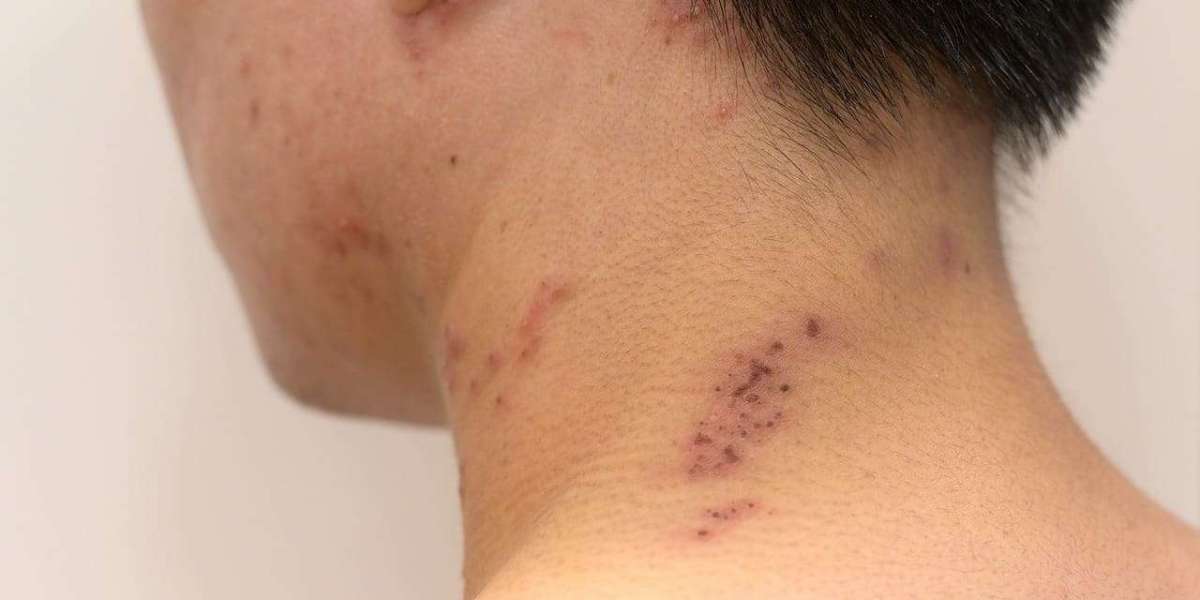 Cervical Fusion Scar Information A Real Patient Guide 2