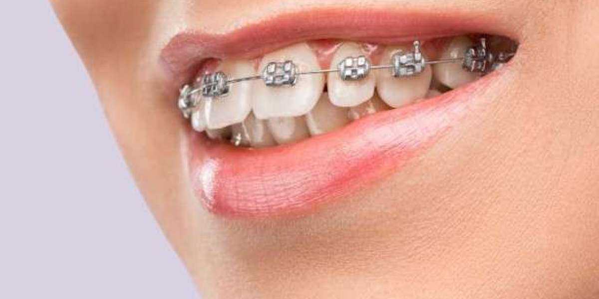 How To Take Care of Braces – Precautions and Tips