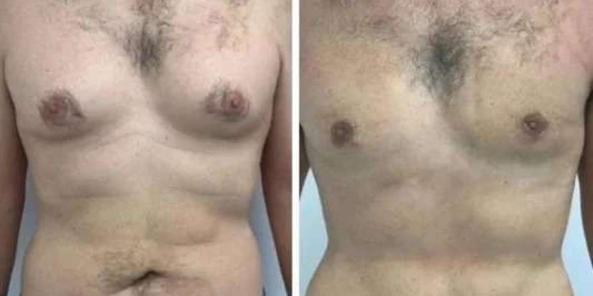 Gynecomastia Surgery in Dubai: Changes That Enhance Results