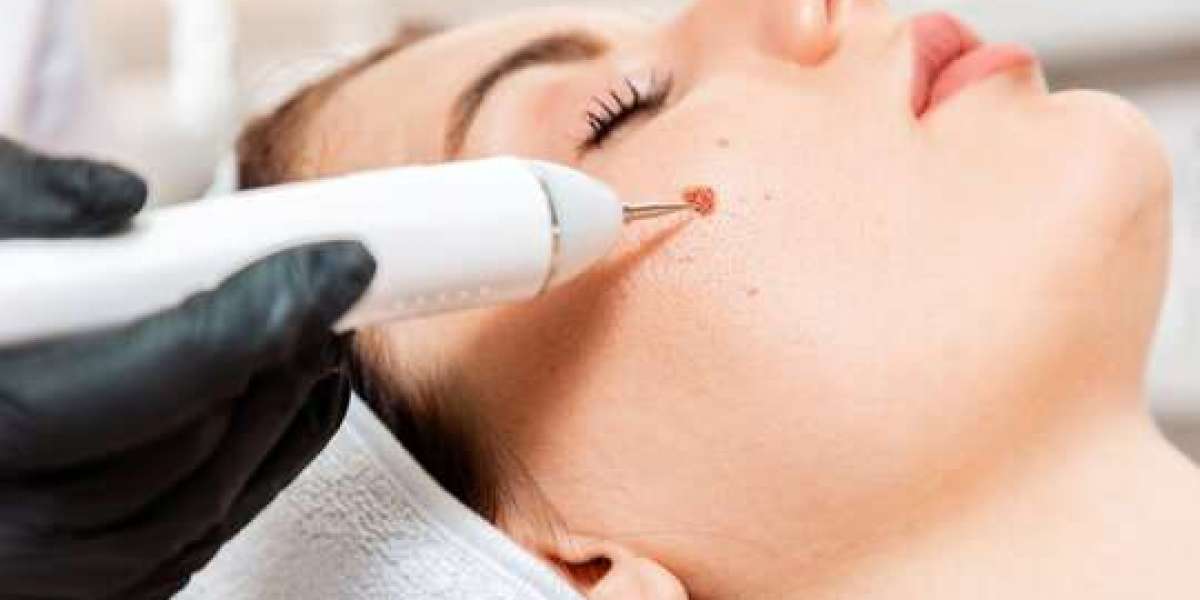 Wart Removal for Stubborn Warts Medical vs At-Home Solutions
