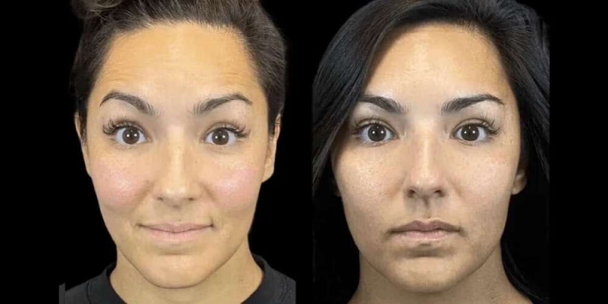 Preventative Botox Strategies Designed by the Best Plastic Surgeon in dubai
