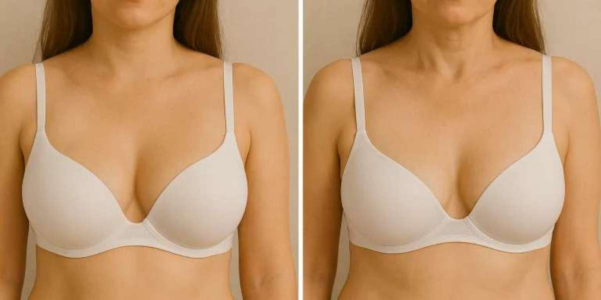 Breast Fat Transfer in Dubai Before and After: What Results Can You Expect?