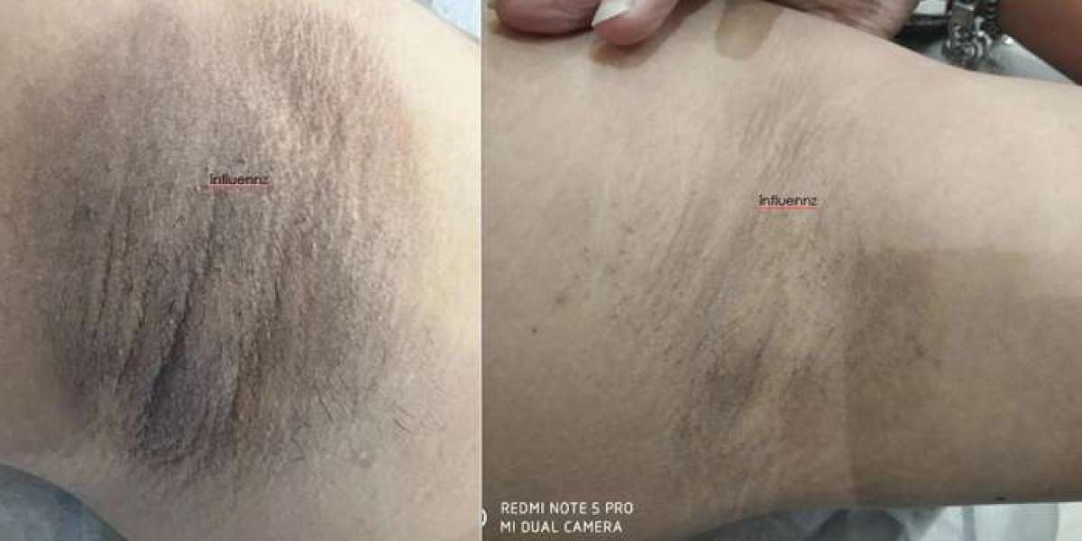 Underarms Pigmentation Treatment in Delhi: Safe & Effective Solutions for Even Skin Tone