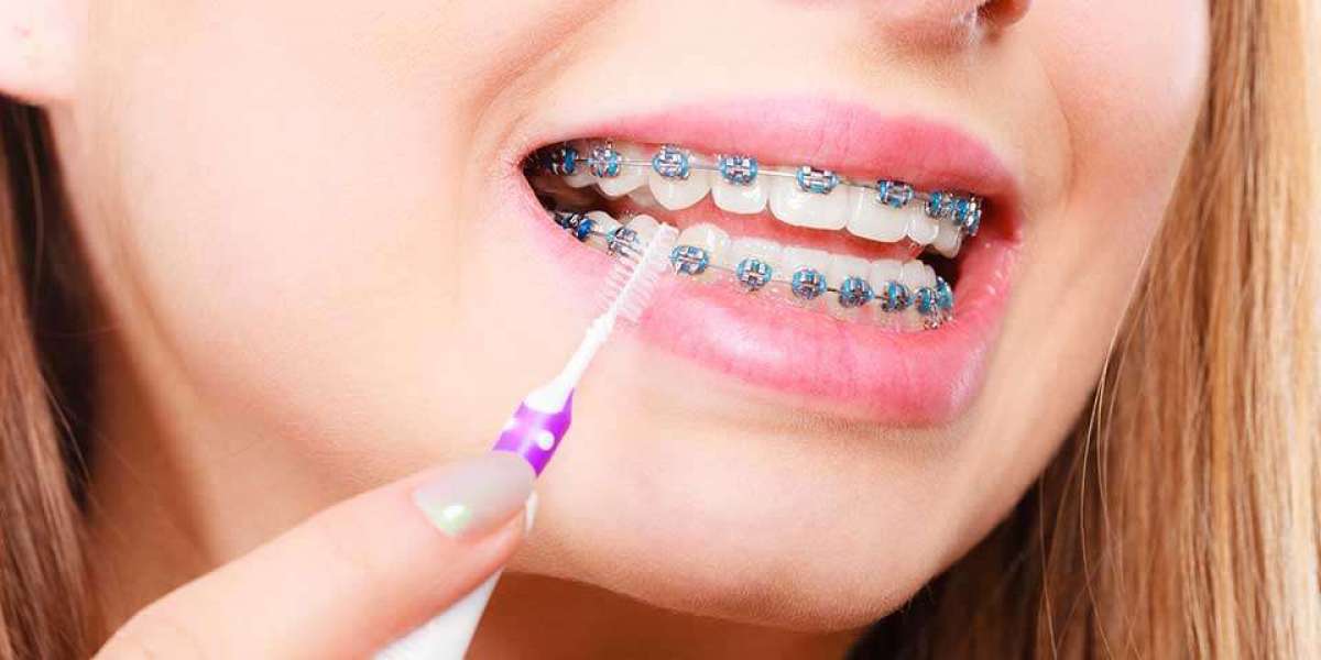 Braces Treatment Care Tips for School Students