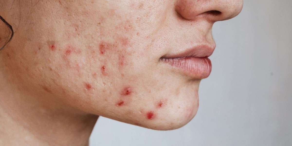 Acne Treatment In Dubai For Clear Healthy And Blemish Free Skin