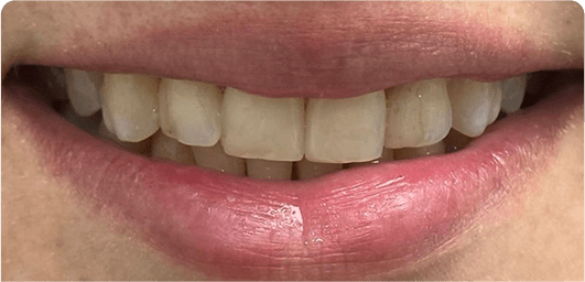 Porcelain Veneers Miami - Deluxe Smile Design | Aesthetic Solutions