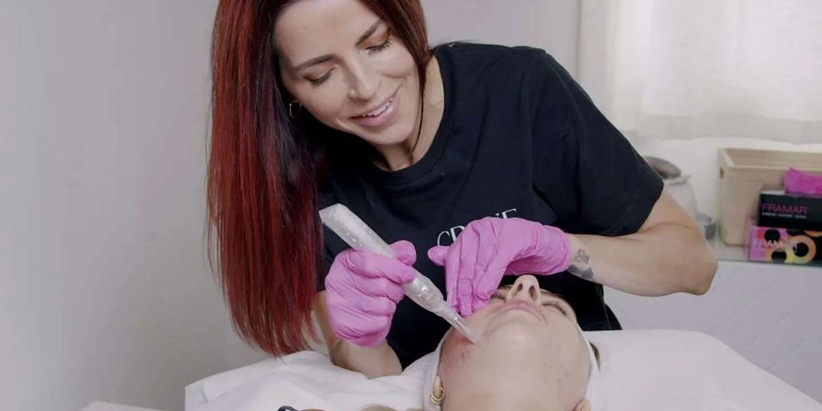 Microneedling London Ontario