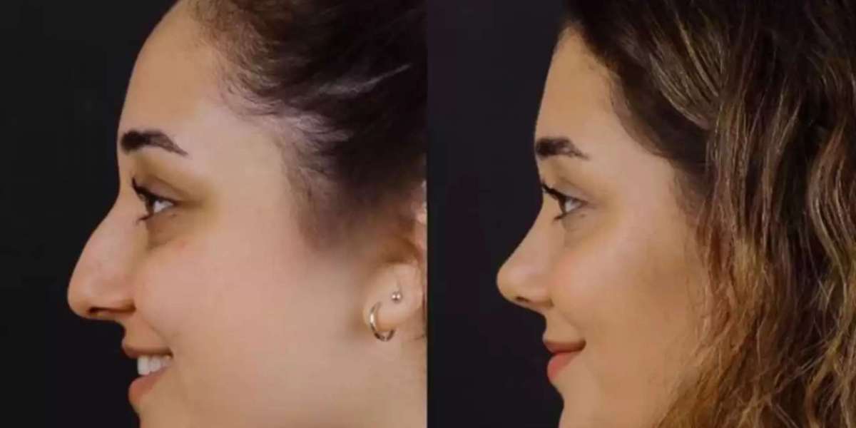 Best Septoplasty Surgeons in Dubai and Valve Protection
