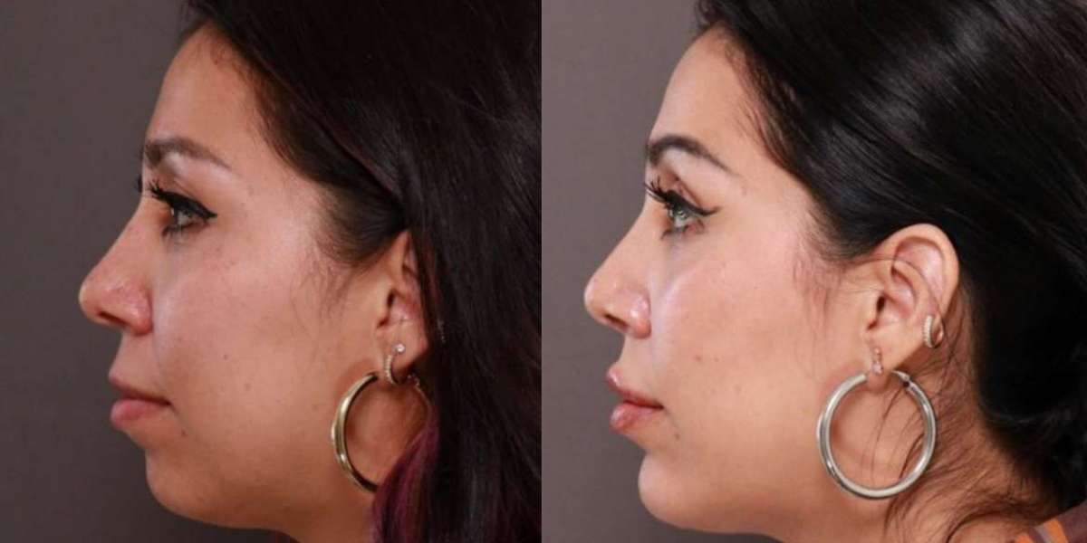 Can rhinoplasty be combined with other facial procedures in Dubai?