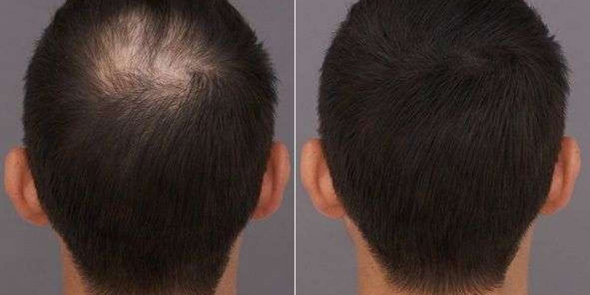 How Long Does A Hair Transplant Last Permanent?