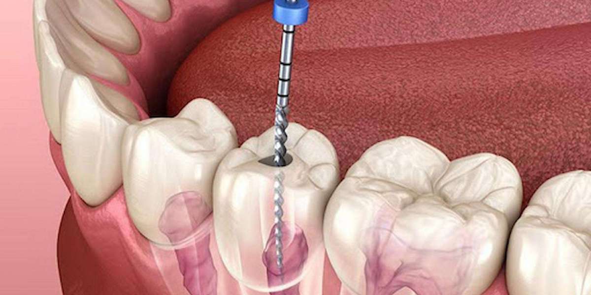 Understanding the Essentials of Root Canal Treatment in Parel Mumbai