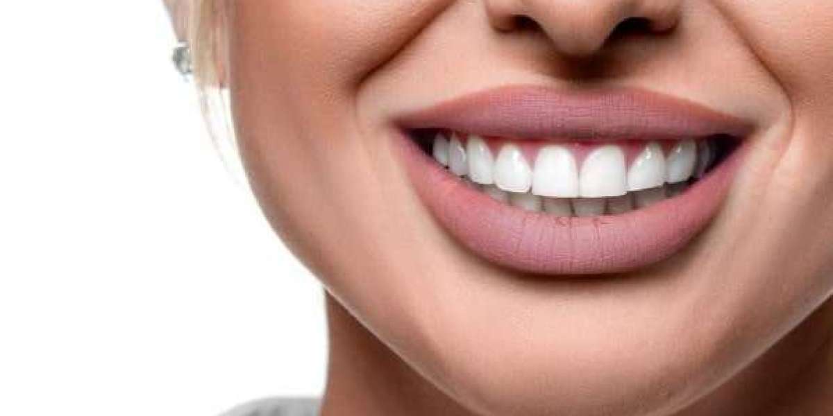 Luxury Hollywood Smile Makeover in Dubai by Experts
