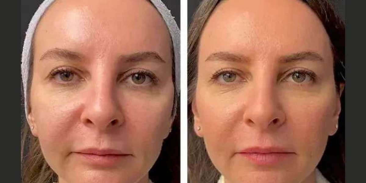 Body Contouring and Fat Reduction by the Best Doctors in Dubai with Mesotherapy