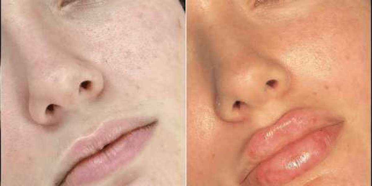 Fillers Treatments in Dubai: Elevate Your Beauty Routine