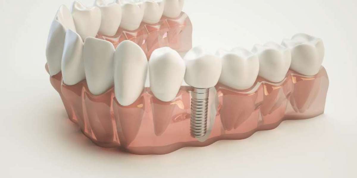 Maintenance Protocols for Long-Lasting Dental Implant Treatment