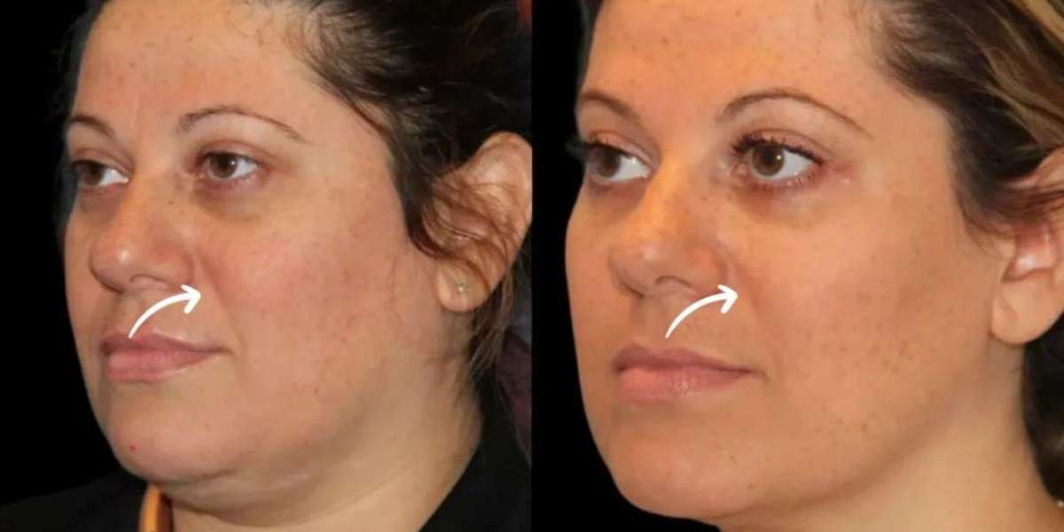 Sculptra Fillers Treatment in Dubai for Volume Correction