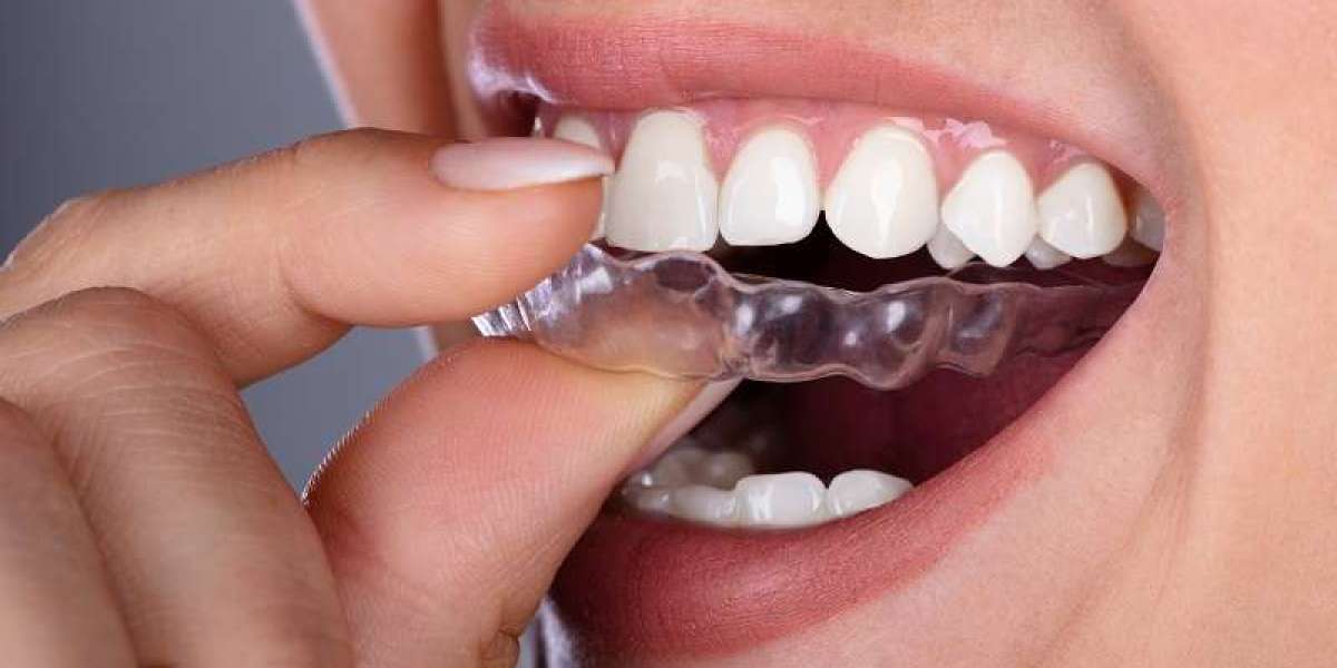 Clear Aligners: A Modern and Comfortable Way to Straighten Your Teeth