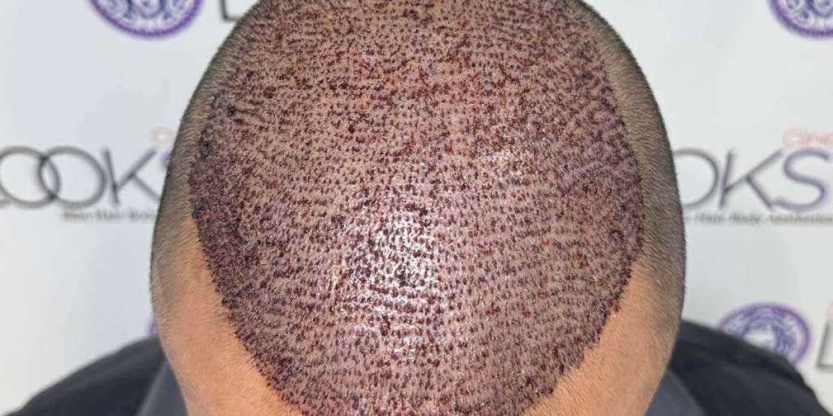 Hair Transplant in Lahore: Your Complete Guide to Hair Restoration in Pakistan's Cultural Capital