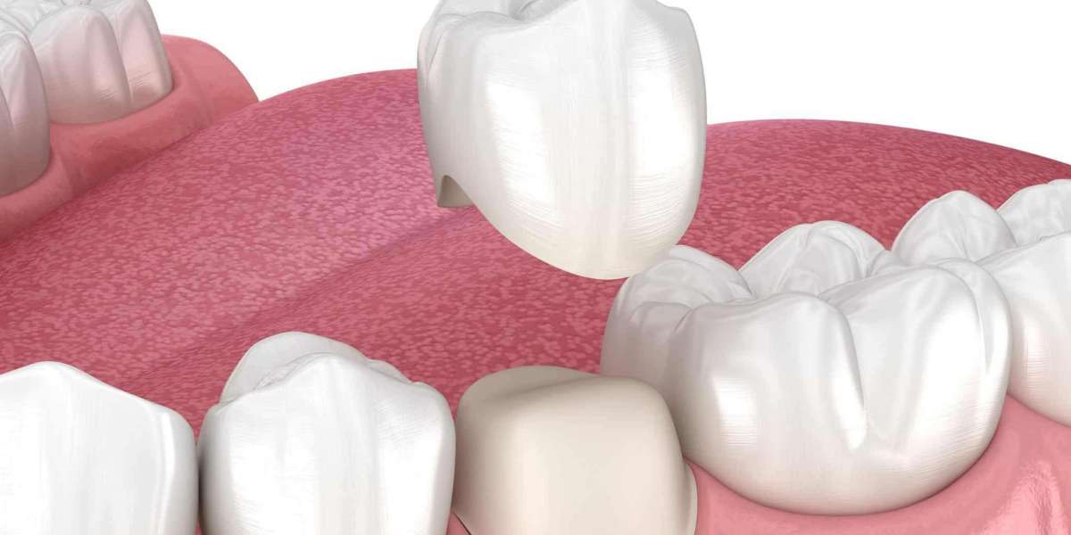 Understanding Your Options and the Dental Crown Cost in Parel Mumbai