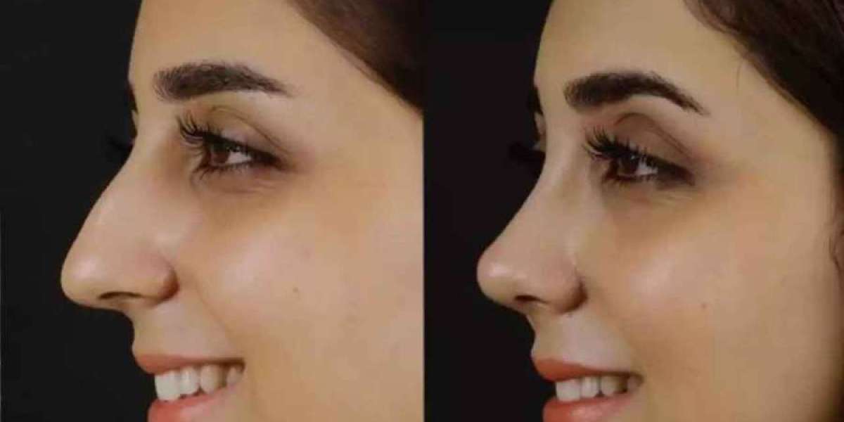 Best Septoplasty Surgeons in Dubai: Evaluating Surgical Depth