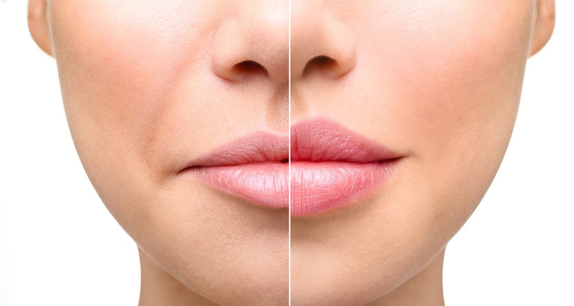 Dermal Fillers Richmond Hill - Lip, Cheek, and Wrinkle Enhancements