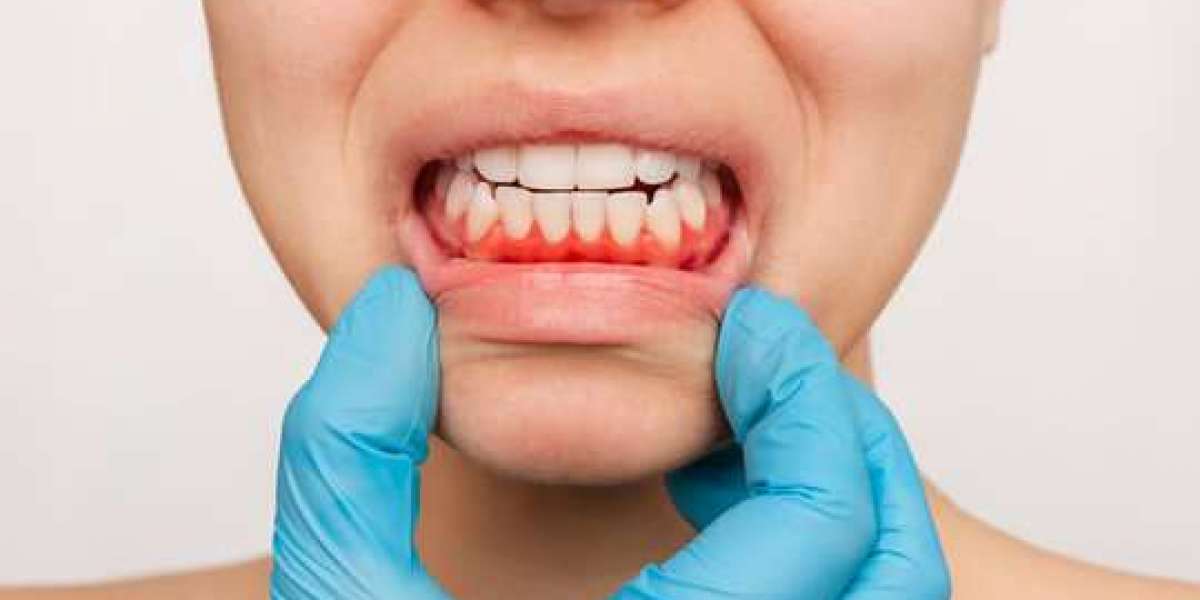 Gum Treatment in Baramati: Cost, Procedure, and Benefits