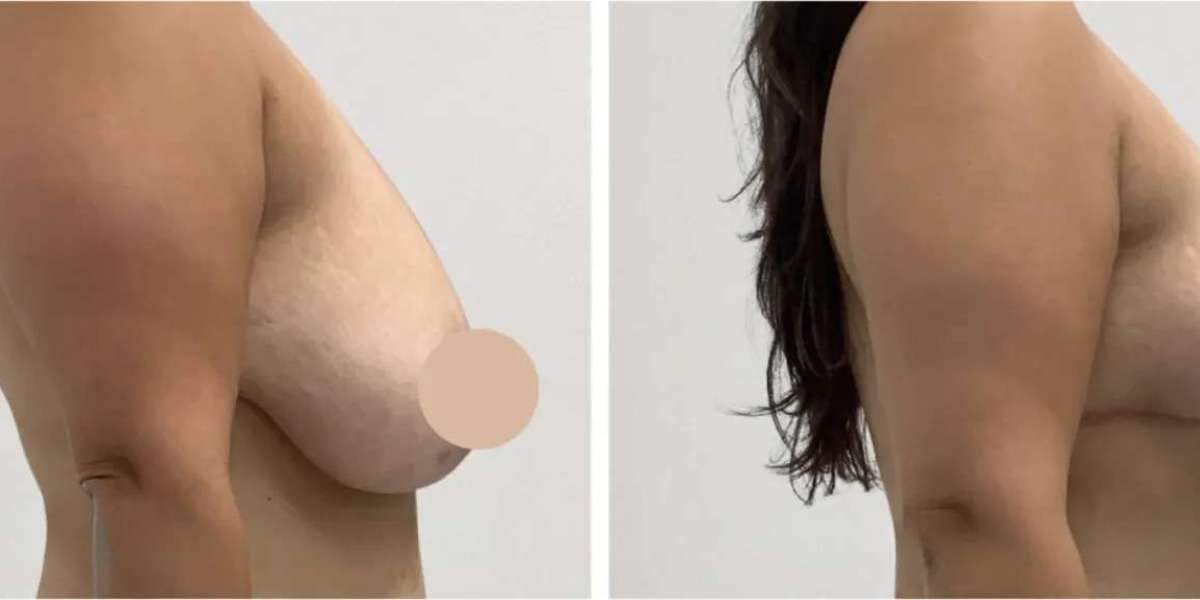 Breast Lift in Dubai: Advanced Techniques for Natural Outcomes