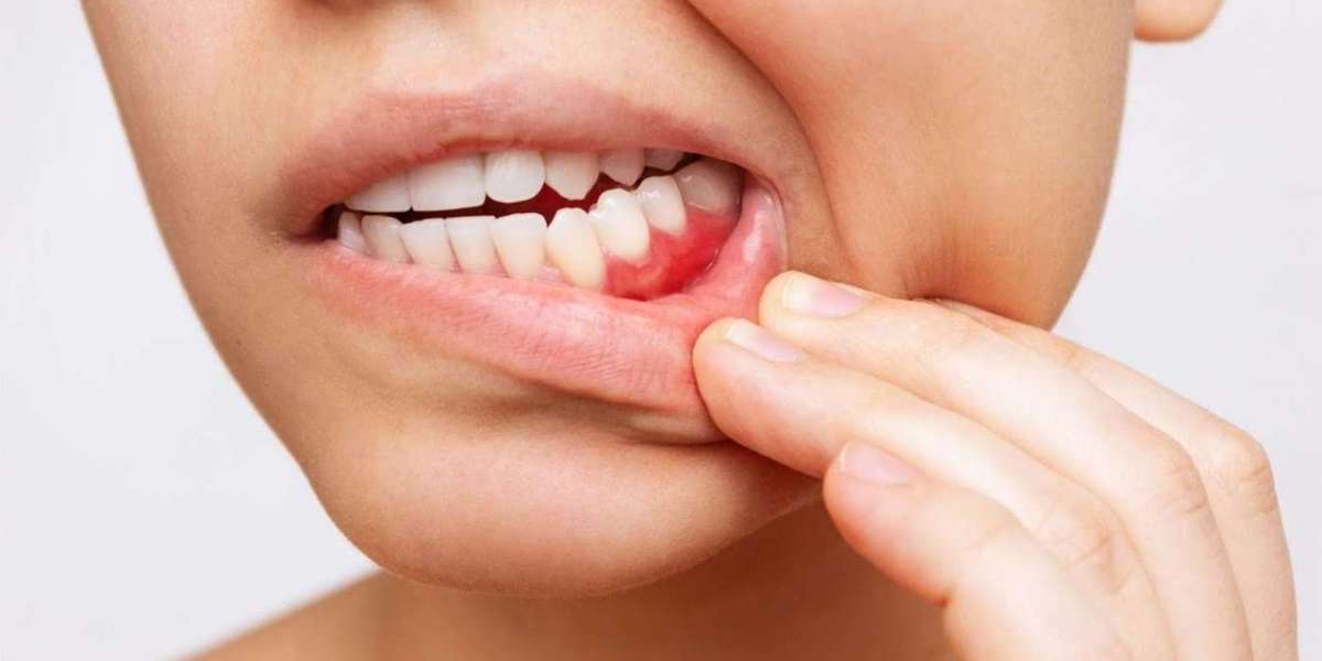 Bleeding Gums: Causes, Treatment, and Why Early Care Matters