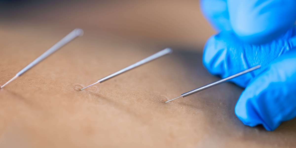 Acupuncture Hormonal Balance | Natural Hormone Support at Hannah Integrative Health