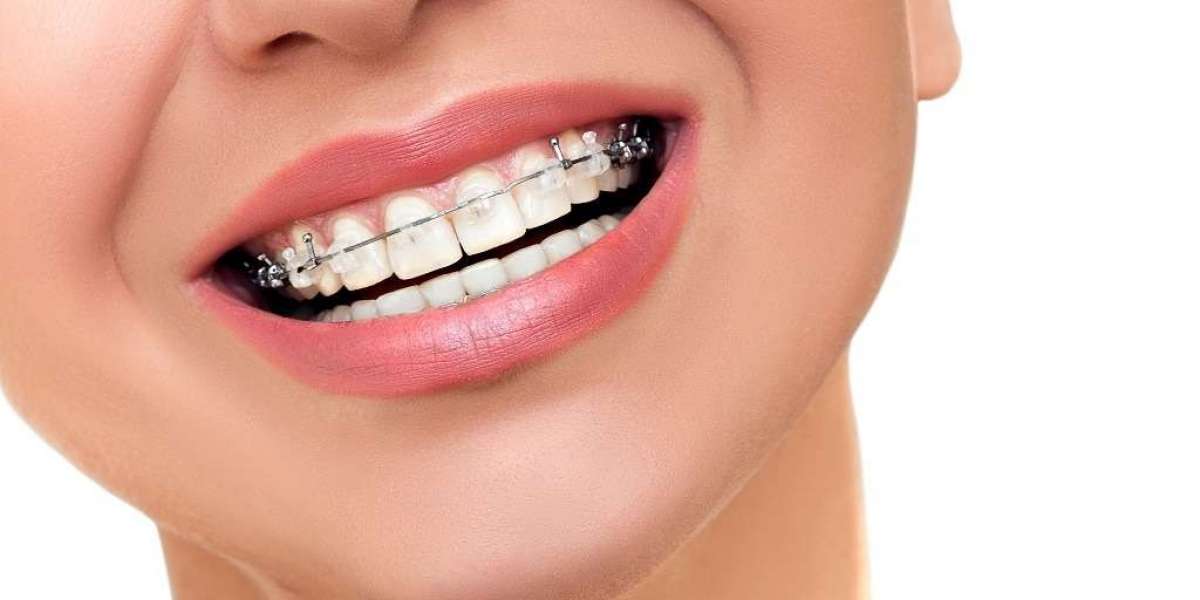 Myths vs Facts About Braces Treatment