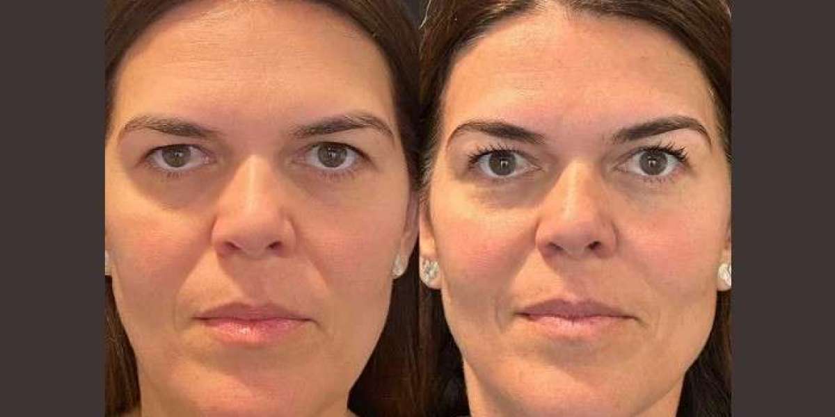 Benefits of Thread Lift Treatments in Dubai for Youthful Skin