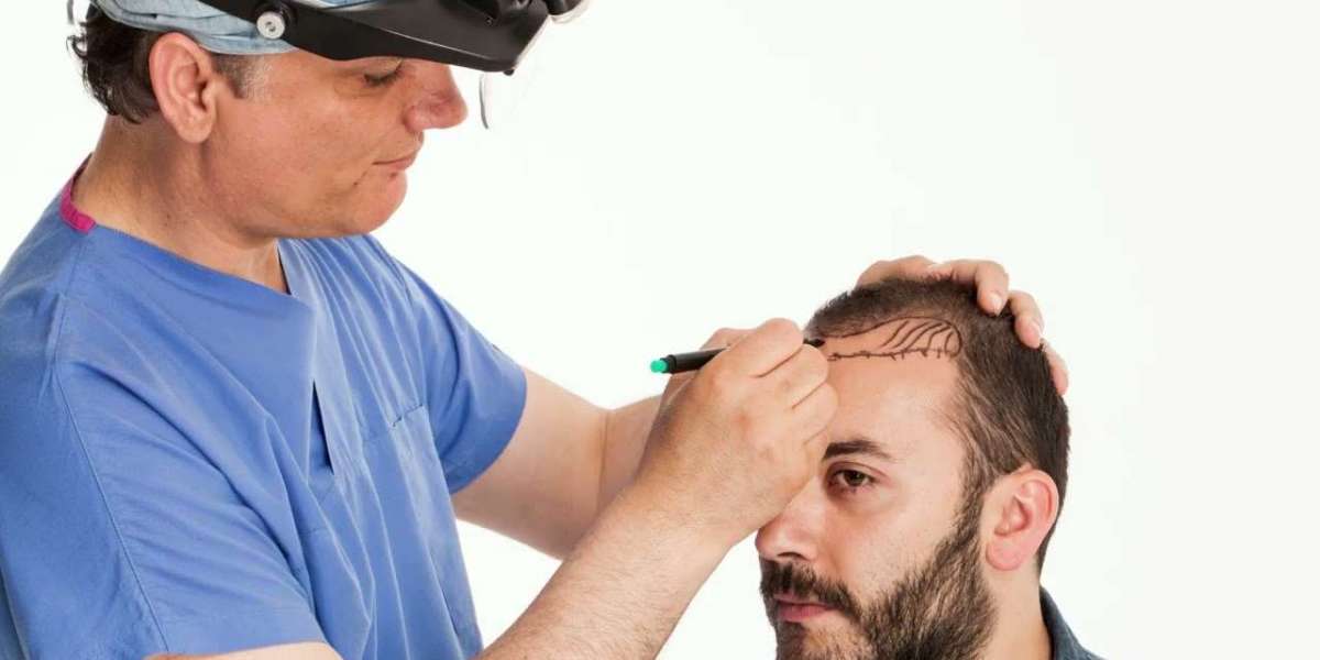 Sapphire FUE vs. DHI: Choosing the Right Technique for Your Needs in Al-Qassim
