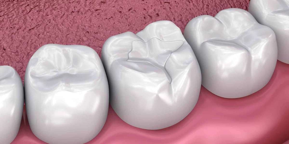 Restoring Your Smile Naturally with Tooth Coloured Filling in Parel Mumbai