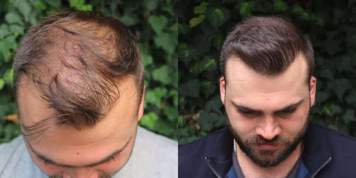زراعة الشعر في دبي.. الجودة العالمية التي تستحقها