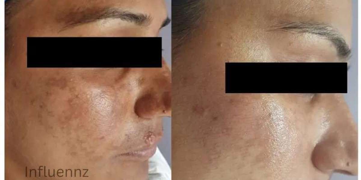 Pigmentation Specialist in Delhi – Expert Care for Clear and Even Skin Tone