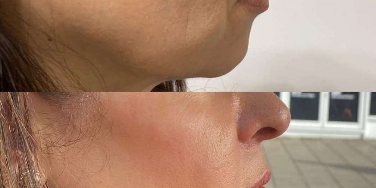 Jawline Filler London: The Quiet Trend Changing Face Shapes in London