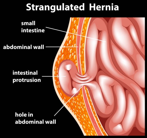 Best Hernia Surgeon NJ: Expert Care for Hernia Repair – Nihalani Group LLC
