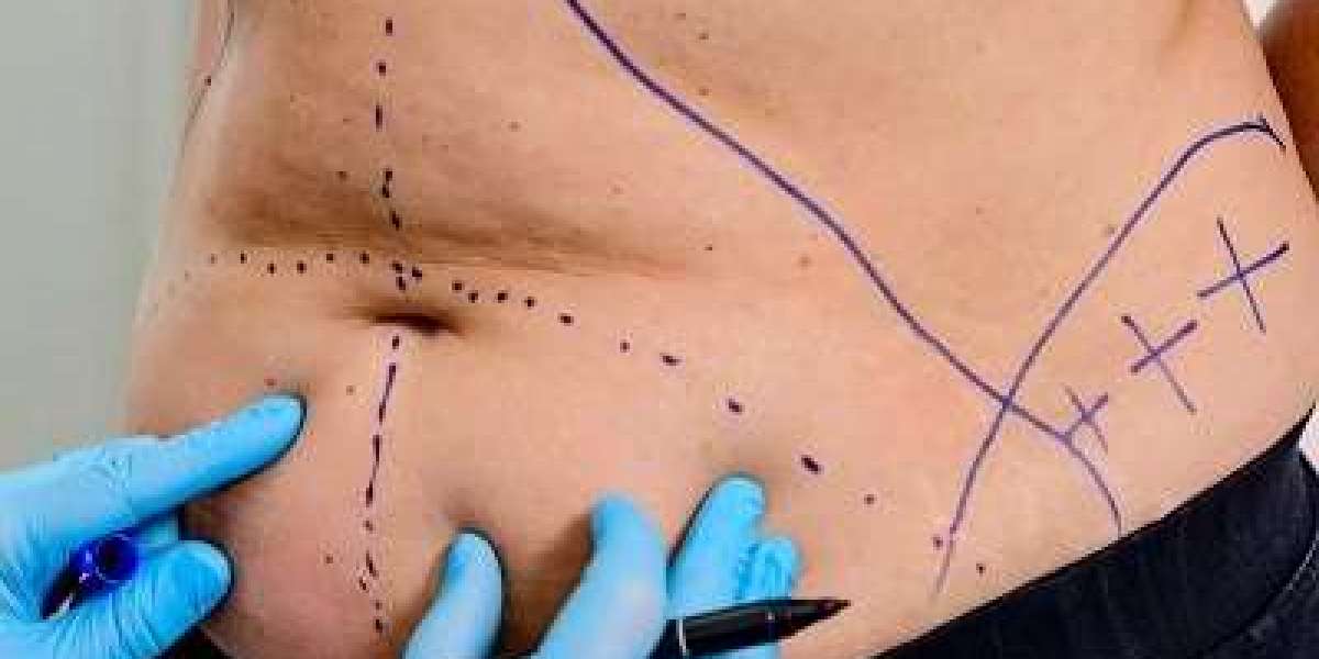 Body Contouring Transformation Riyadh