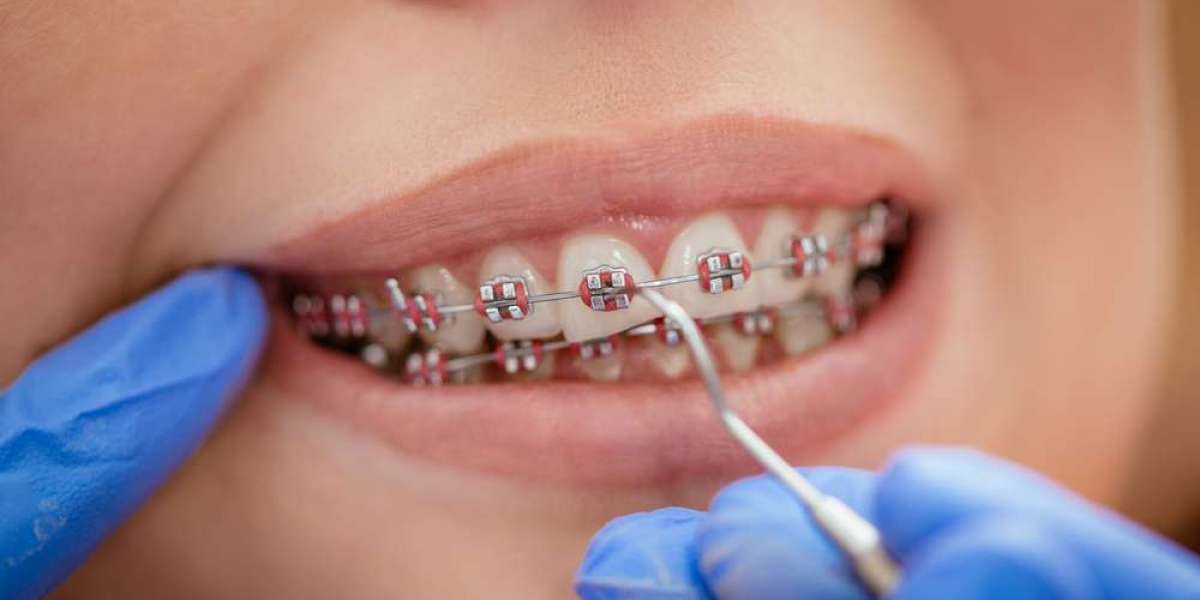 Modern Orthodontics: Your Guide to Braces Treatment in Parel Mumbai for a Straighter Smile