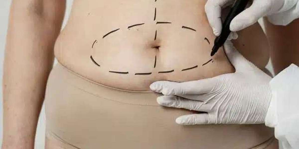 Mini vs Full Tummy Tuck in Dubai: Pros, Cons, and Differences