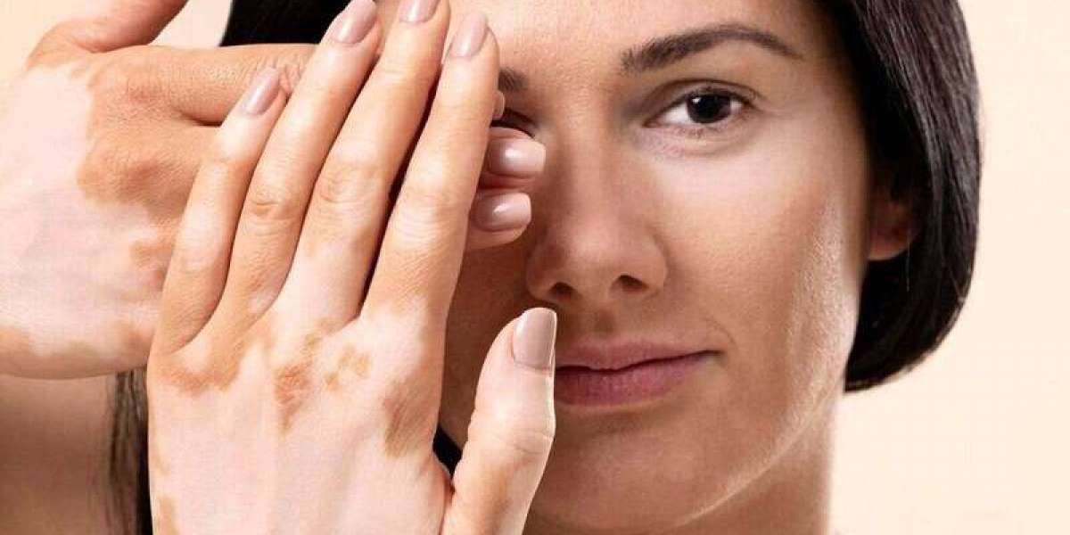 Understanding Skin Whitening Treatment for Vitiligo Patients and Its Benefits
