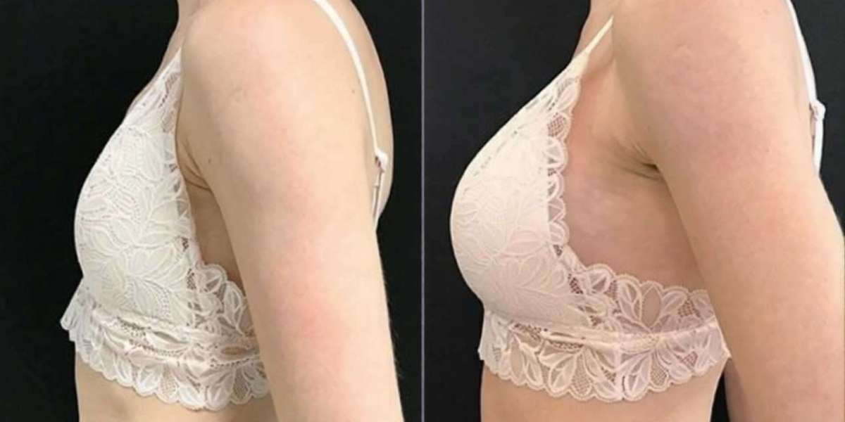 True Breast Enlargement Injections in Islamabad